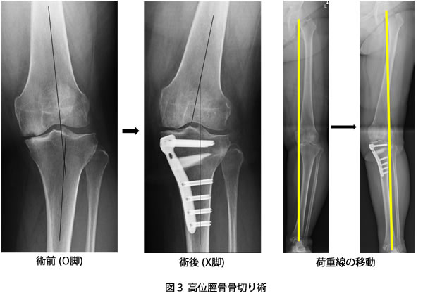 高位脛骨骨切り術