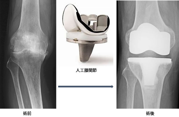 人工膝関節全置換術