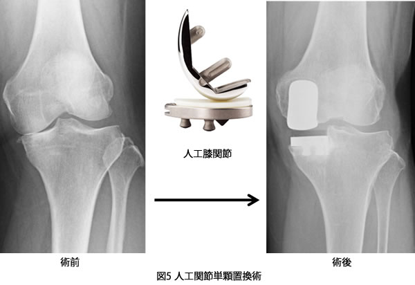 人工膝関節単顆（片側）置換術