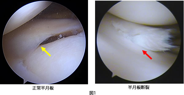 半月板損傷