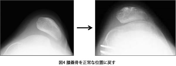 手術方法