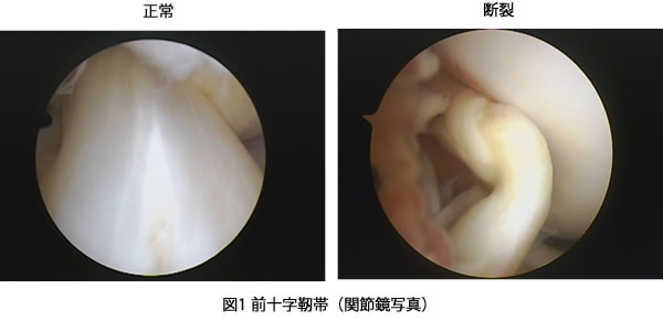 前十字靭帯損傷