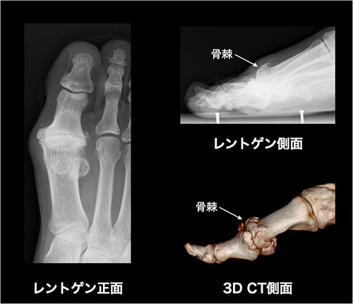 【画像】強剛母趾