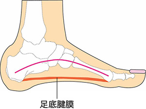 【画像】足底腱膜