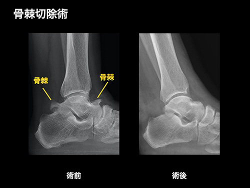 【画像】棘切除