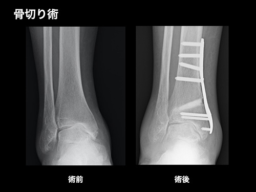 【画像】骨切り