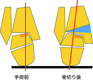 【画像】骨切り