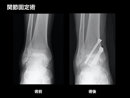 【画像】関節固定術