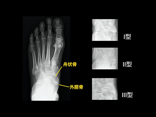 【画像】有痛性外脛骨