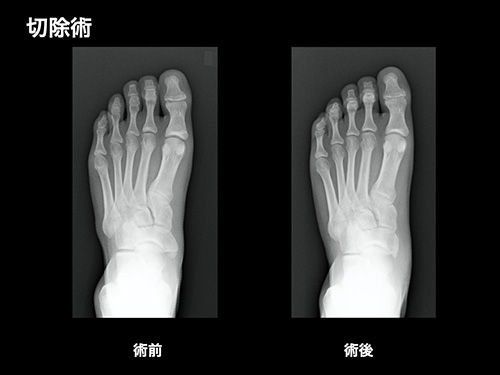 【画像】骨切除術