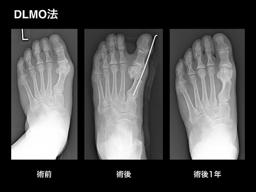 病 手術 モートン モートン病の手術経験者のかたはおれますか？