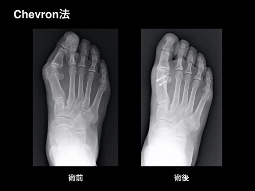 【画像】外反母趾の手術療法・中足骨遠位骨切り術（Chevron法 シェブロン法）