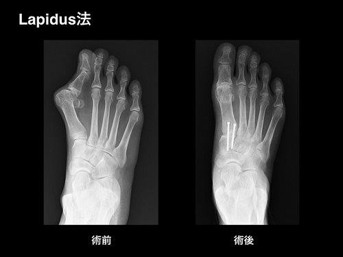 【画像】外反母趾の手術療法・関節固定術（Lapidus法 ラピダス法）