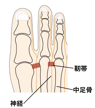 【画像】モートン神経種