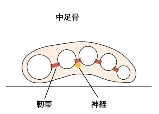 【画像】モートン神経種