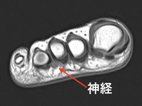 【画像】モートン神経種